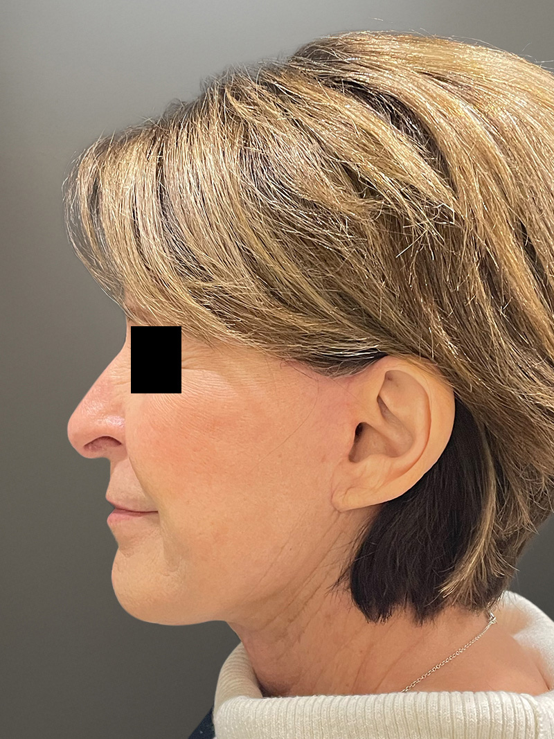 FAT GRAFTING Before & After Gallery - Patient 368601 - Image 10