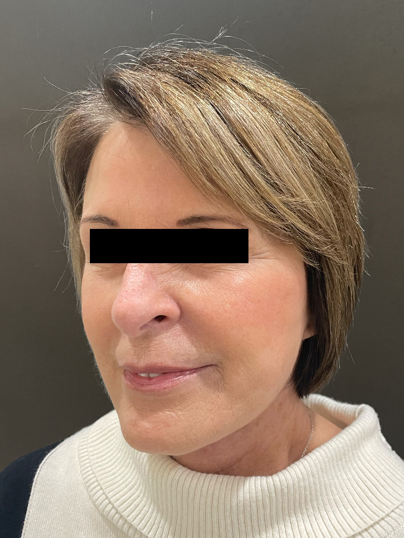 FAT GRAFTING Before & After Gallery - Patient 368601 - Image 8