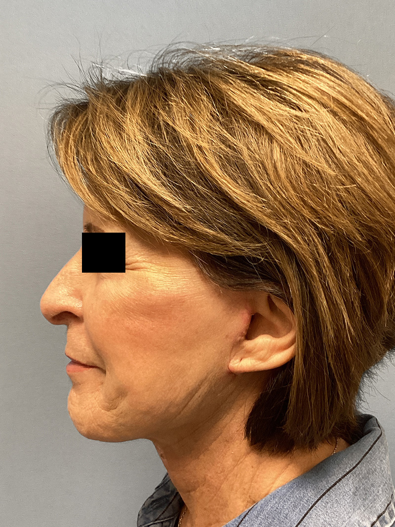 FAT GRAFTING Before & After Gallery - Patient 368601 - Image 9