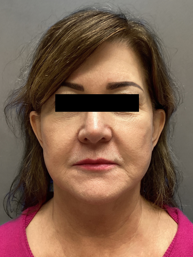 FAT GRAFTING Before & After Gallery - Patient 613645 - Image 1