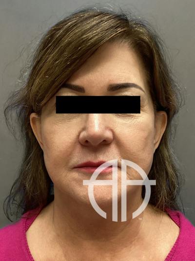 FAT GRAFTING Before & After Gallery - Patient 613645 - Image 1