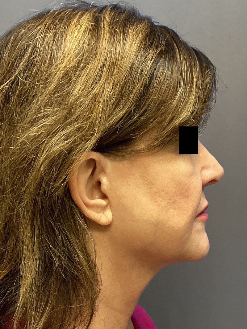 FAT GRAFTING Before & After Gallery - Patient 613645 - Image 5