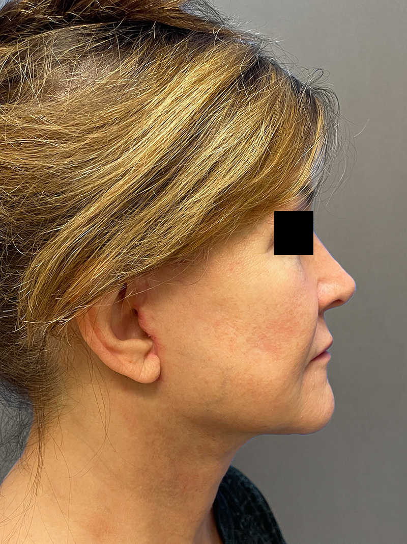 FAT GRAFTING Before & After Gallery - Patient 613645 - Image 6