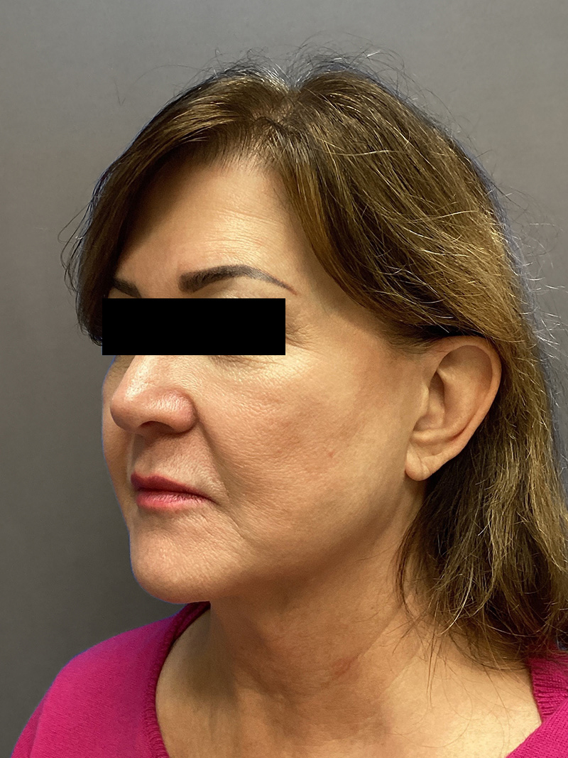 FAT GRAFTING Before & After Gallery - Patient 613645 - Image 7