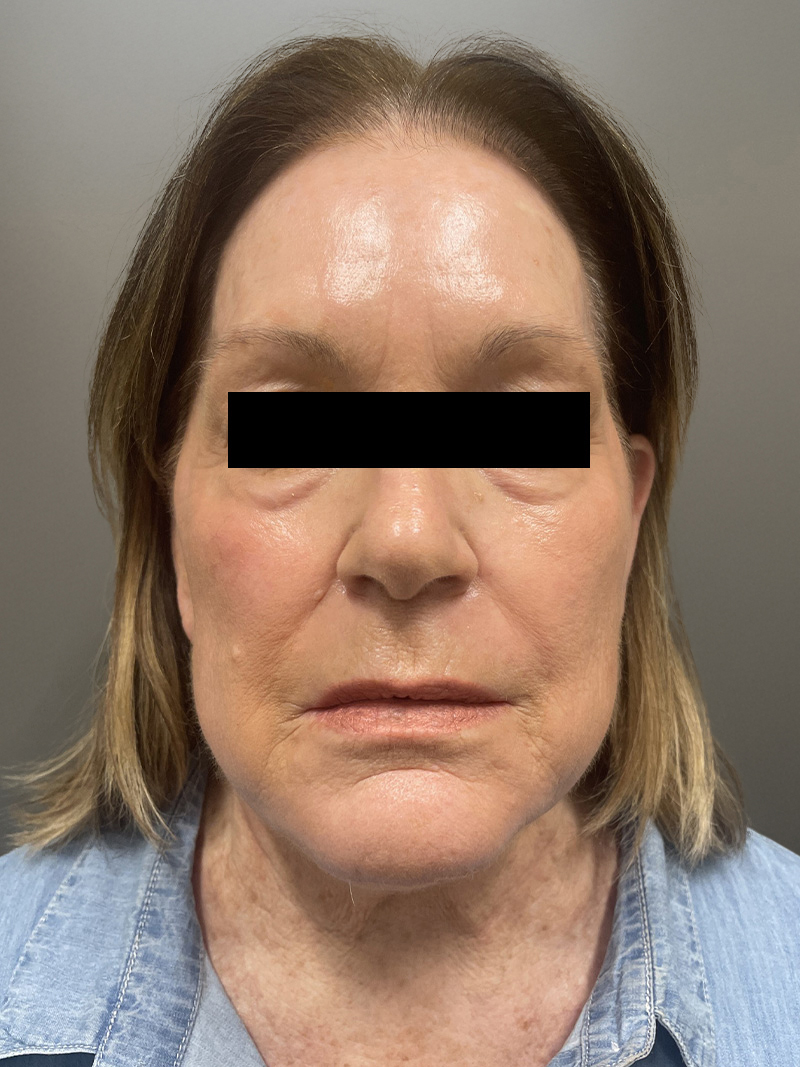 FAT GRAFTING Before & After Gallery - Patient 664715 - Image 1