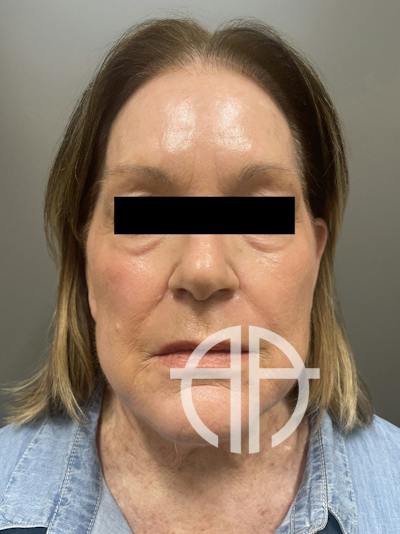 FAT GRAFTING Before & After Gallery - Patient 664715 - Image 1
