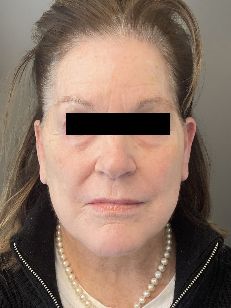 FAT GRAFTING Before & After Gallery - Patient 664715 - Image 2
