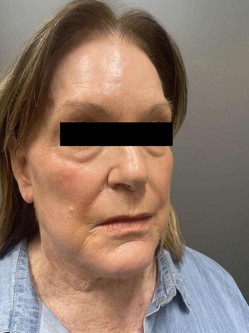 FAT GRAFTING Before & After Gallery - Patient 664715 - Image 3