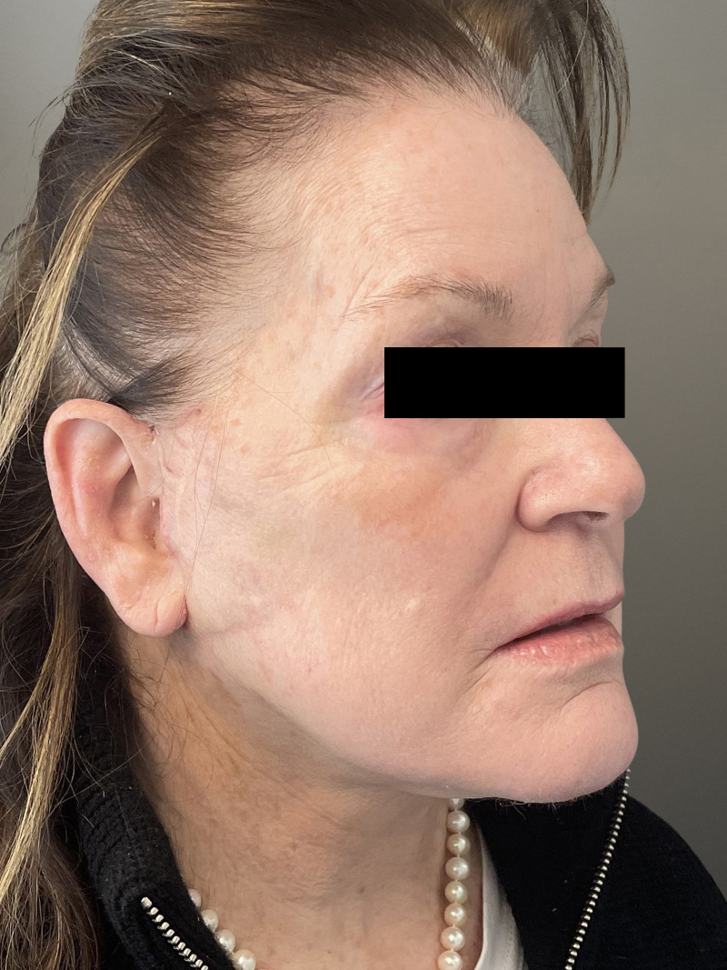 FAT GRAFTING Before & After Gallery - Patient 664715 - Image 4