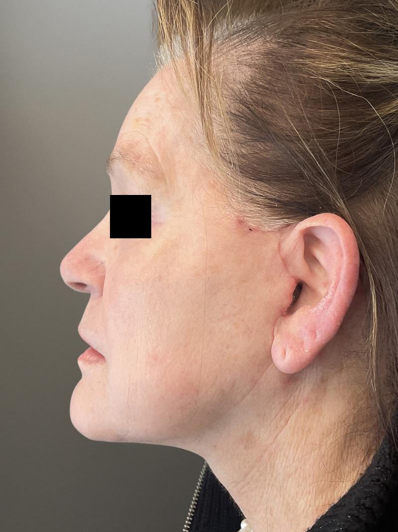 FAT GRAFTING Before & After Gallery - Patient 664715 - Image 6