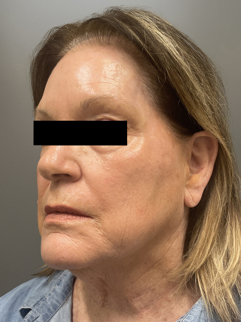 FAT GRAFTING Before & After Gallery - Patient 664715 - Image 7