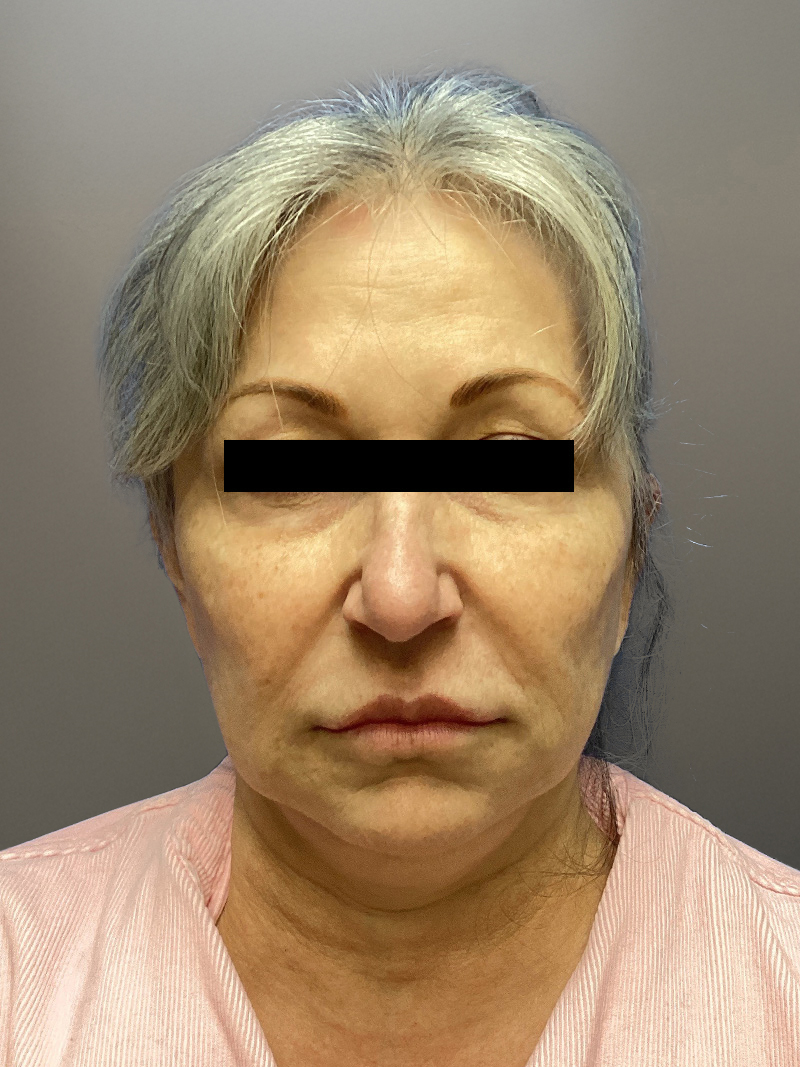 FAT GRAFTING Before & After Gallery - Patient 690628 - Image 1