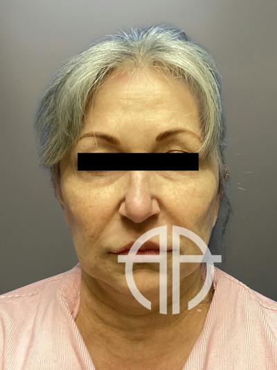 FAT GRAFTING Before & After Gallery - Patient 690628 - Image 1