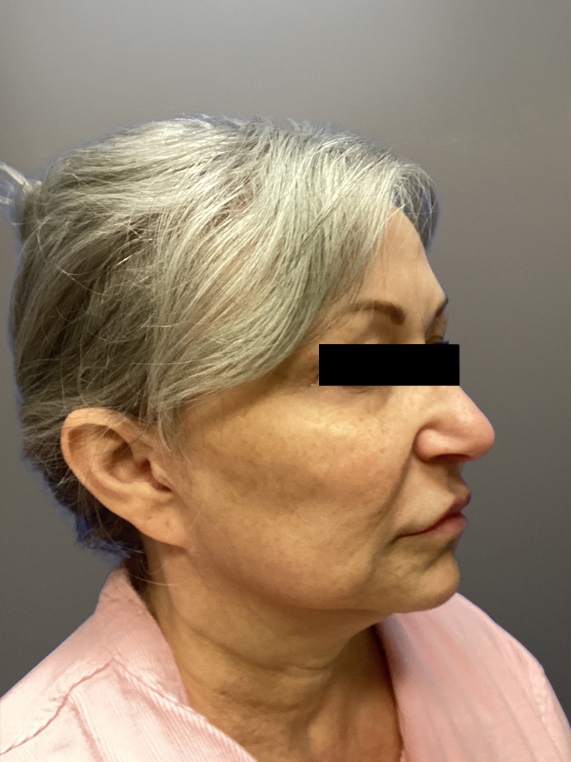 FAT GRAFTING Before & After Gallery - Patient 690628 - Image 3