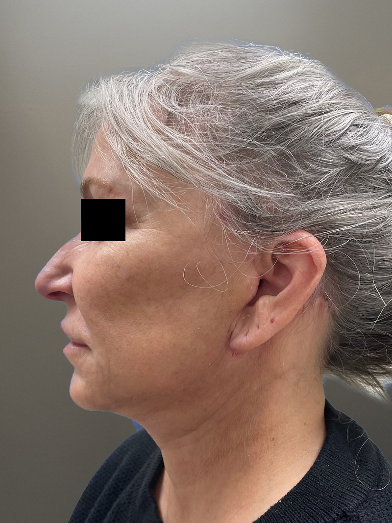 FAT GRAFTING Before & After Gallery - Patient 690628 - Image 10