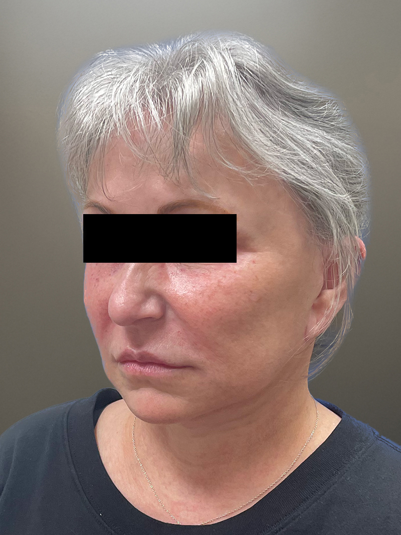 FAT GRAFTING Before & After Gallery - Patient 690628 - Image 8