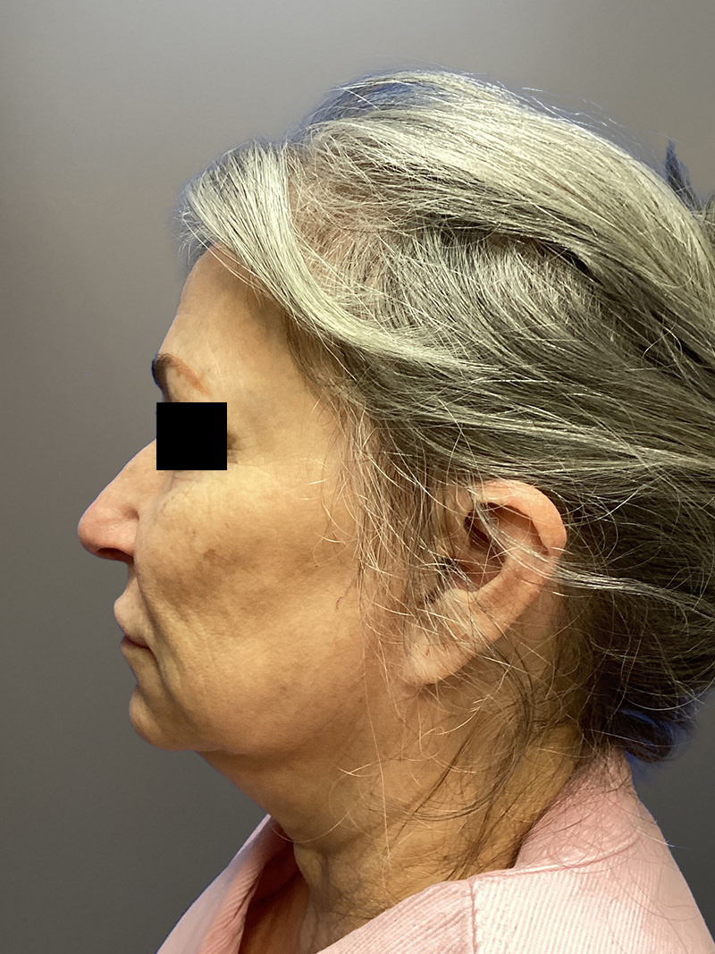 FAT GRAFTING Before & After Gallery - Patient 690628 - Image 9