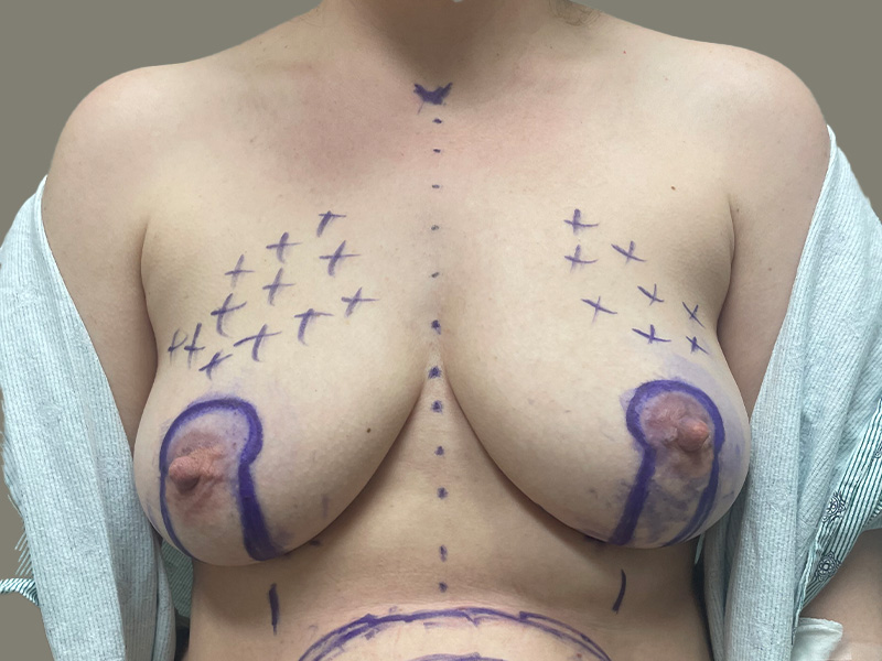 BREAST LIFT Before & After Gallery - Patient 360184 - Image 1