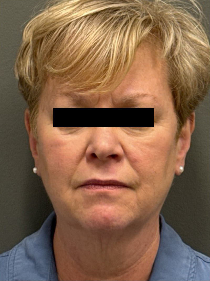 FACELIFT Before & After Gallery - Patient 412361 - Image 1