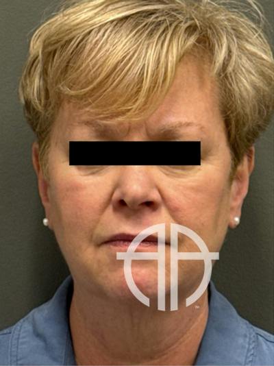 FACELIFT Before & After Gallery - Patient 412361 - Image 1