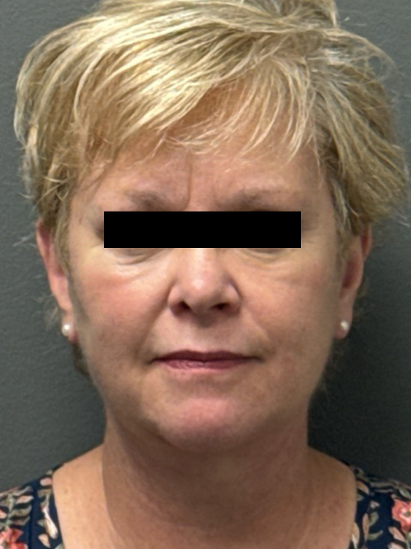 FACELIFT Before & After Gallery - Patient 412361 - Image 2