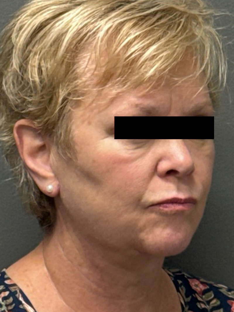 FACELIFT Before & After Gallery - Patient 412361 - Image 4