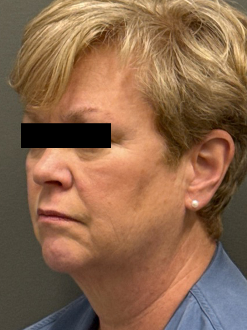 FACELIFT Before & After Gallery - Patient 412361 - Image 5