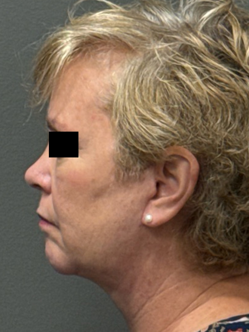 FACELIFT Before & After Gallery - Patient 412361 - Image 8