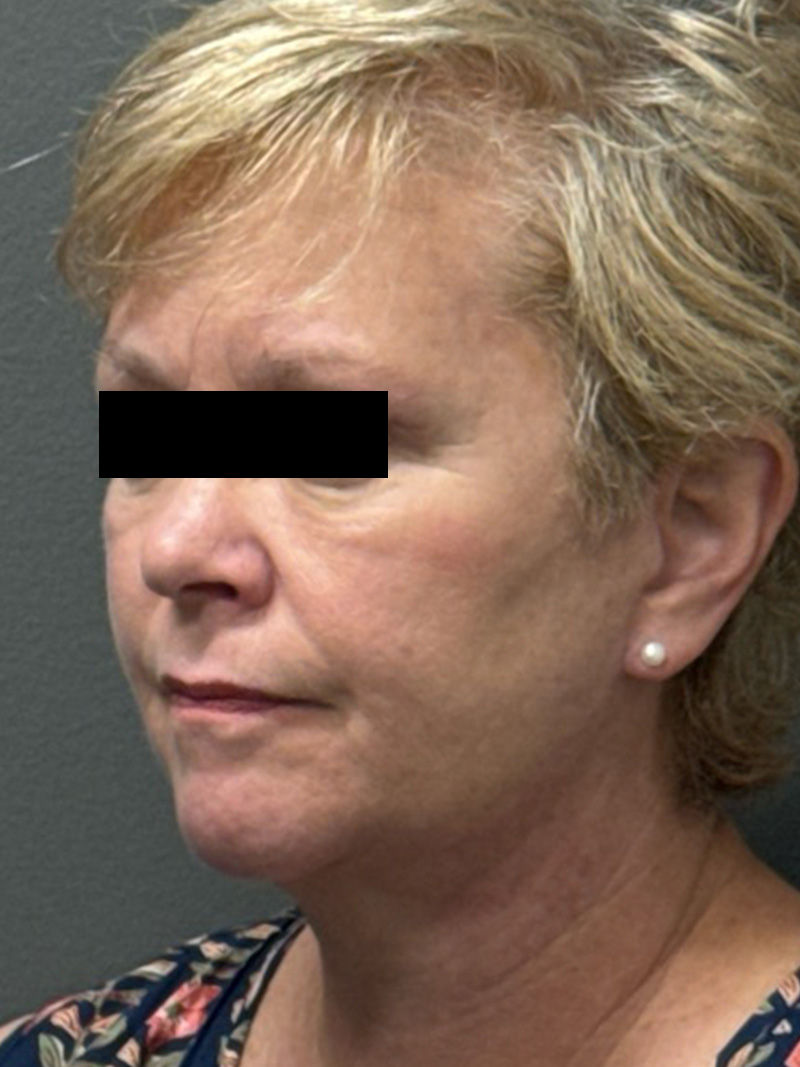 FACELIFT Before & After Gallery - Patient 412361 - Image 6