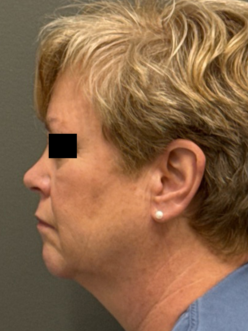 FACELIFT Before & After Gallery - Patient 412361 - Image 7