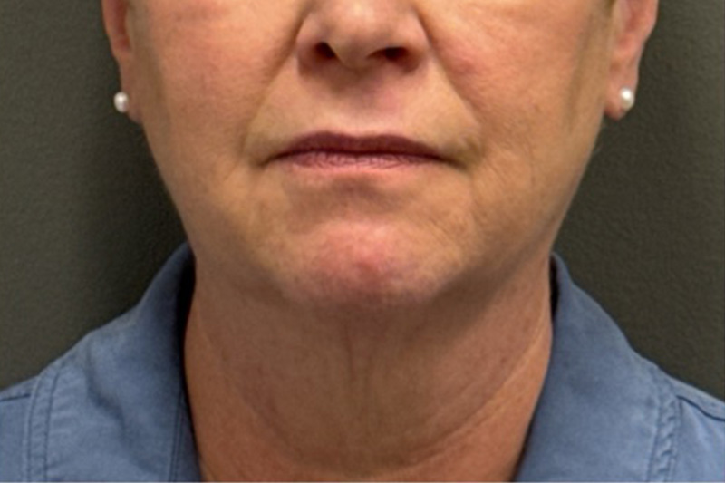 NECK LIFT Before & After Gallery - Patient 290174 - Image 5