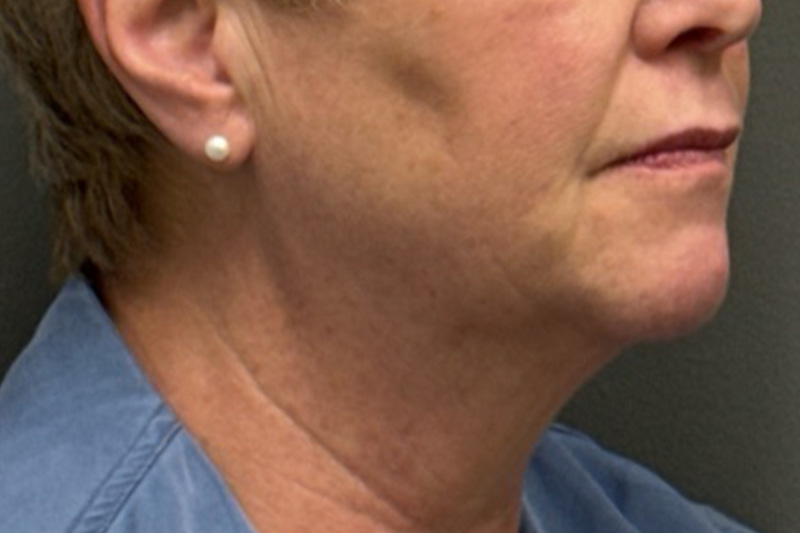 NECK LIFT Before & After Gallery - Patient 290174 - Image 7