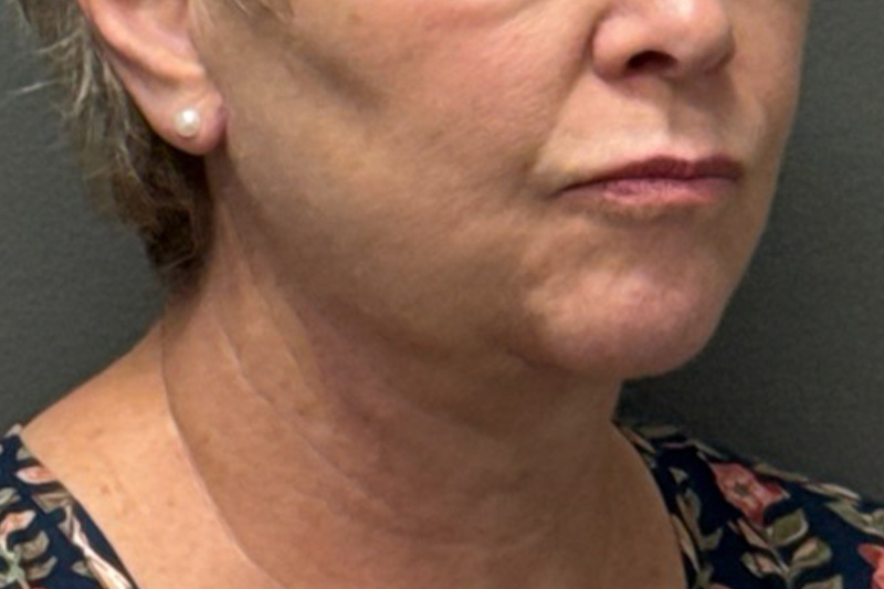 NECK LIFT Before & After Gallery - Patient 290174 - Image 8