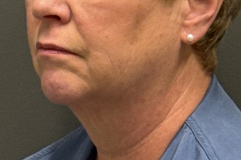 NECK LIFT Before & After Gallery - Patient 290174 - Image 3