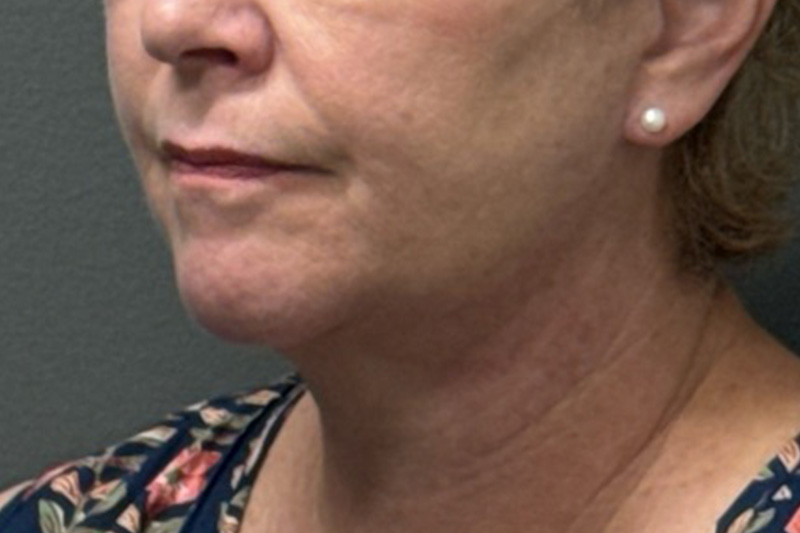 NECK LIFT Before & After Gallery - Patient 290174 - Image 4