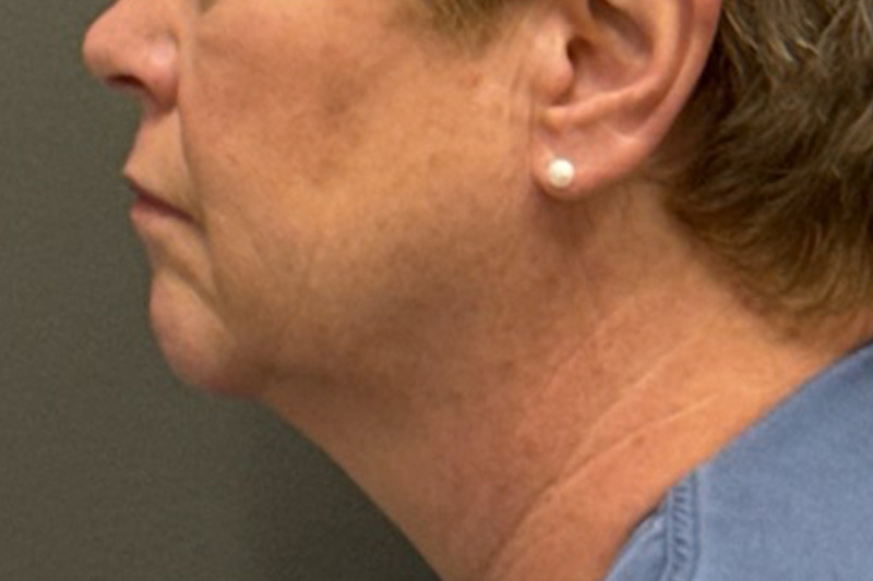NECK LIFT Before & After Gallery - Patient 290174 - Image 1