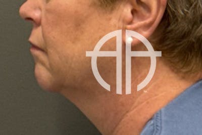 NECK LIFT Before & After Gallery - Patient 290174 - Image 1