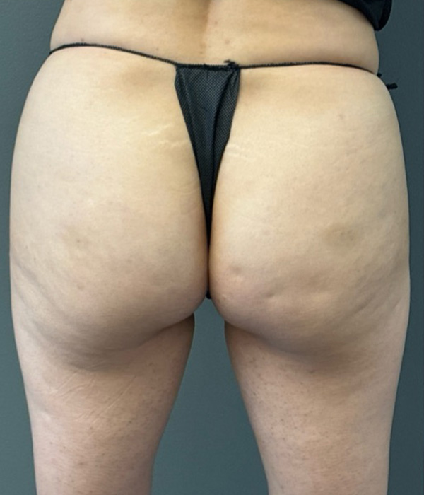 SCULPTRA FOR BUTTOCKS Before & After Gallery - Patient 115281 - Image 1