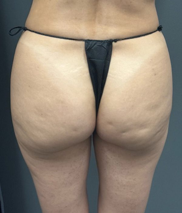 SCULPTRA FOR BUTTOCKS Before & After Gallery - Patient 115281 - Image 2