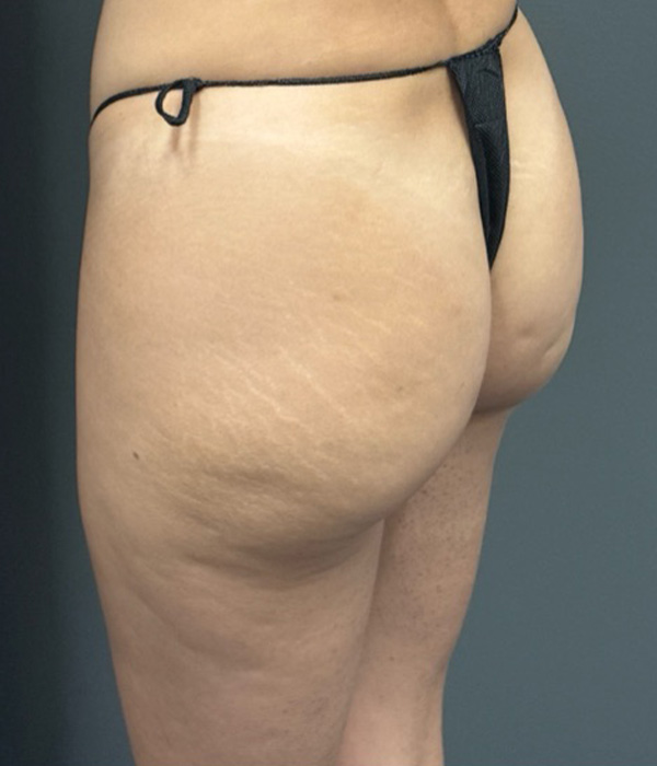 SCULPTRA FOR BUTTOCKS Before & After Gallery - Patient 115281 - Image 4