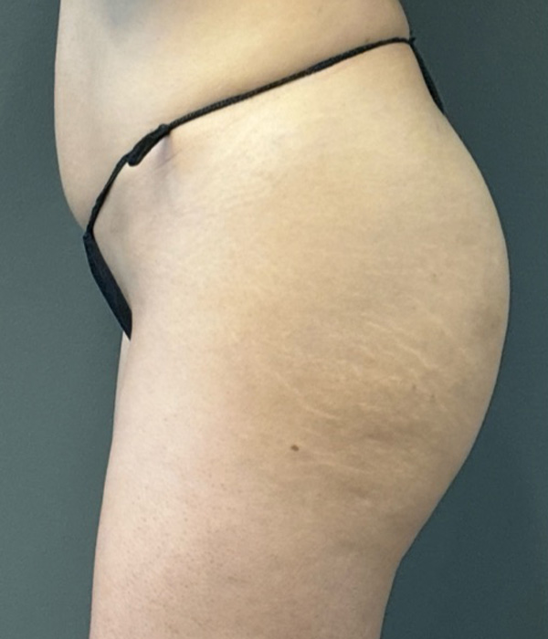SCULPTRA FOR BUTTOCKS Before & After Gallery - Patient 115281 - Image 5