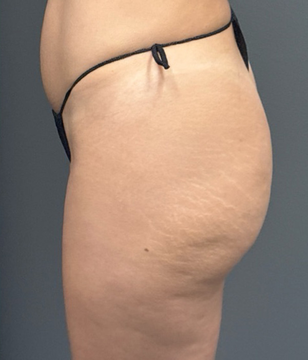 SCULPTRA FOR BUTTOCKS Before & After Gallery - Patient 115281 - Image 6