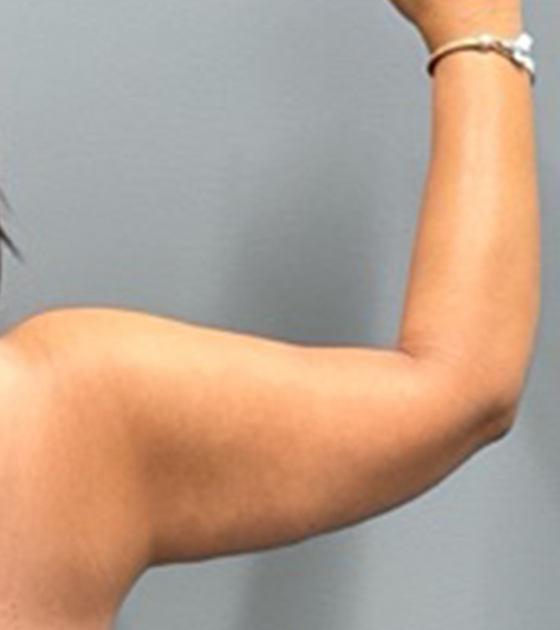 ARM LIFT Before & After Gallery - Patient 312008 - Image 6