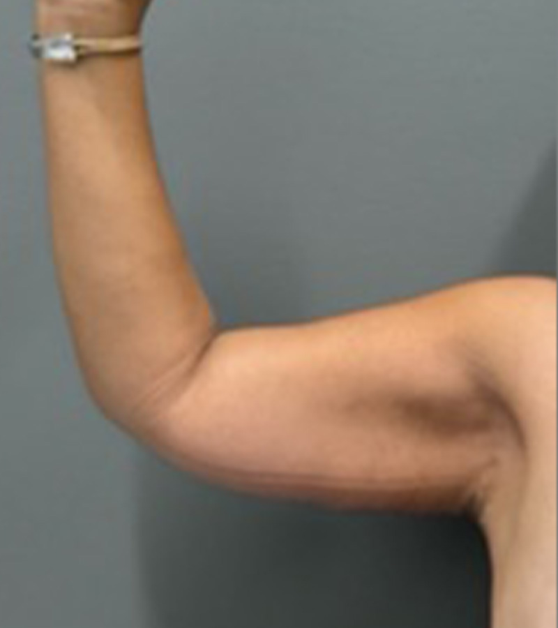 ARM LIFT Before & After Gallery - Patient 312008 - Image 4