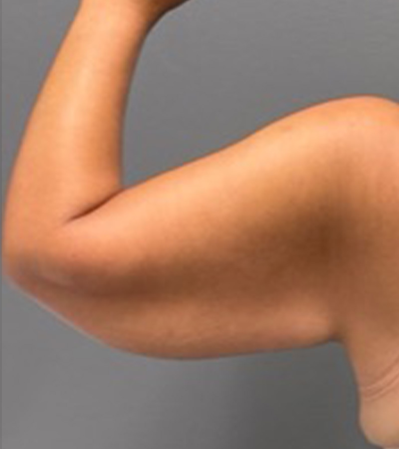 ARM LIFT Before & After Gallery - Patient 312008 - Image 1