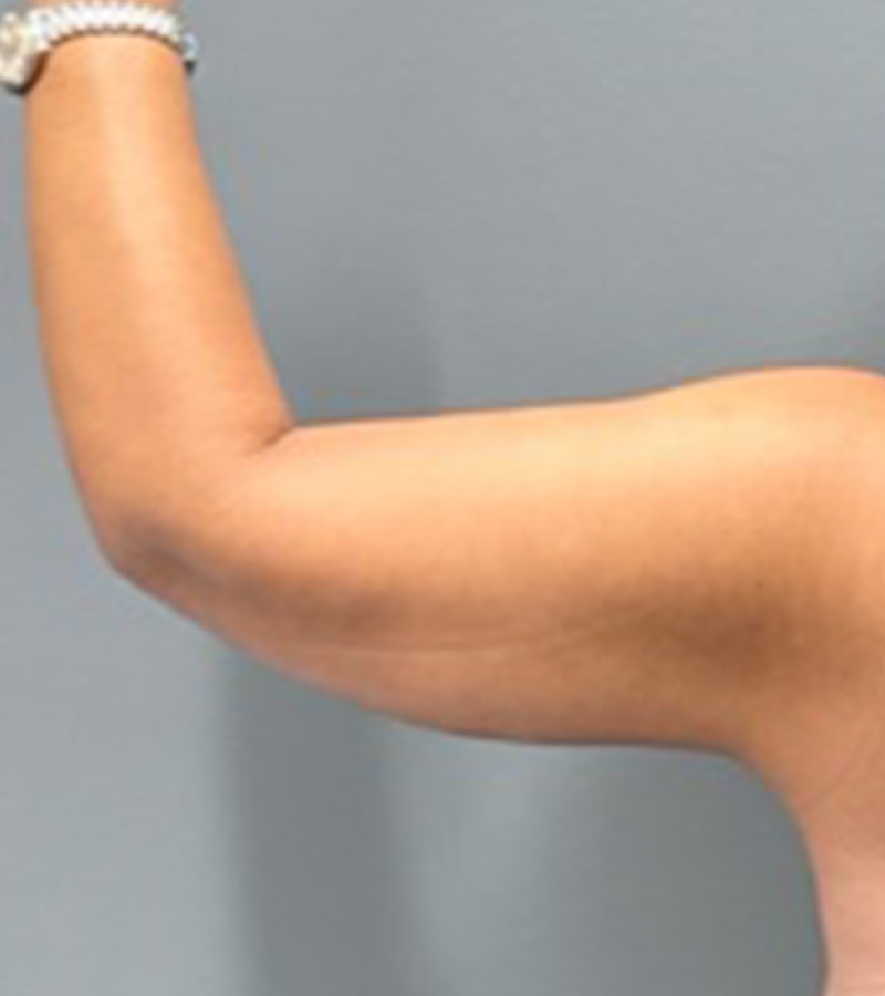 ARM LIFT Before & After Gallery - Patient 312008 - Image 2
