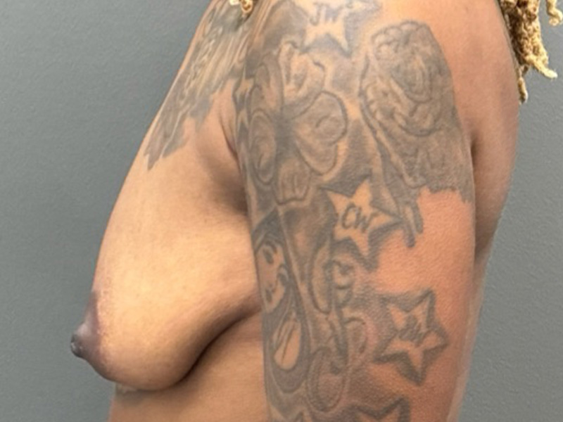 BREAST LIFT Before & After Gallery - Patient 350599 - Image 7