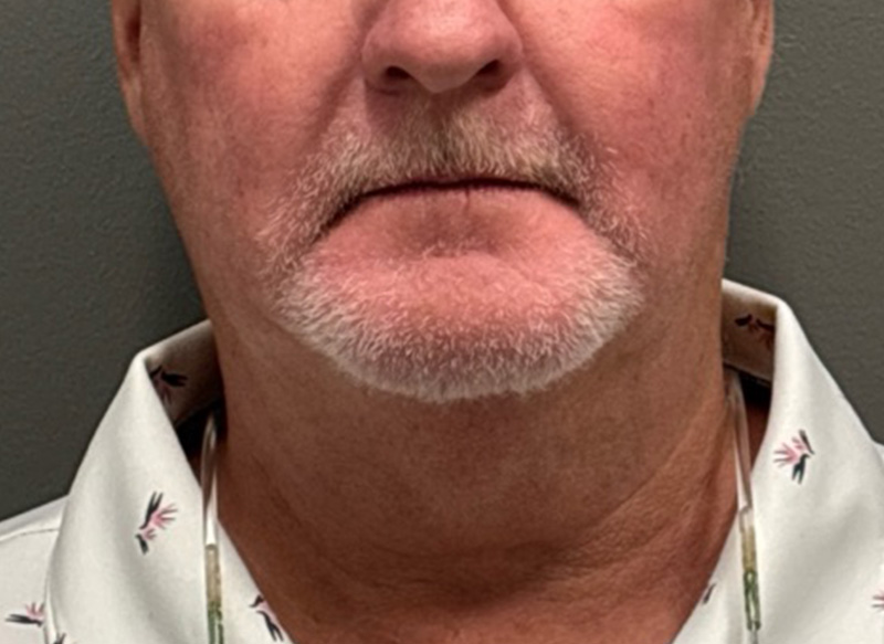 SUBMENTAL LIPOSUCTION Before & After Gallery - Patient 112102 - Image 5