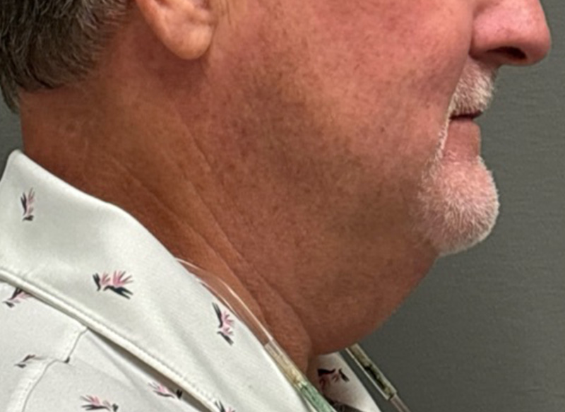 NECK LIFT Before & After Gallery - Patient 835979 - Image 1
