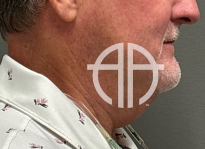 NECK LIFT Before & After Gallery - Patient 835979 - Image 1